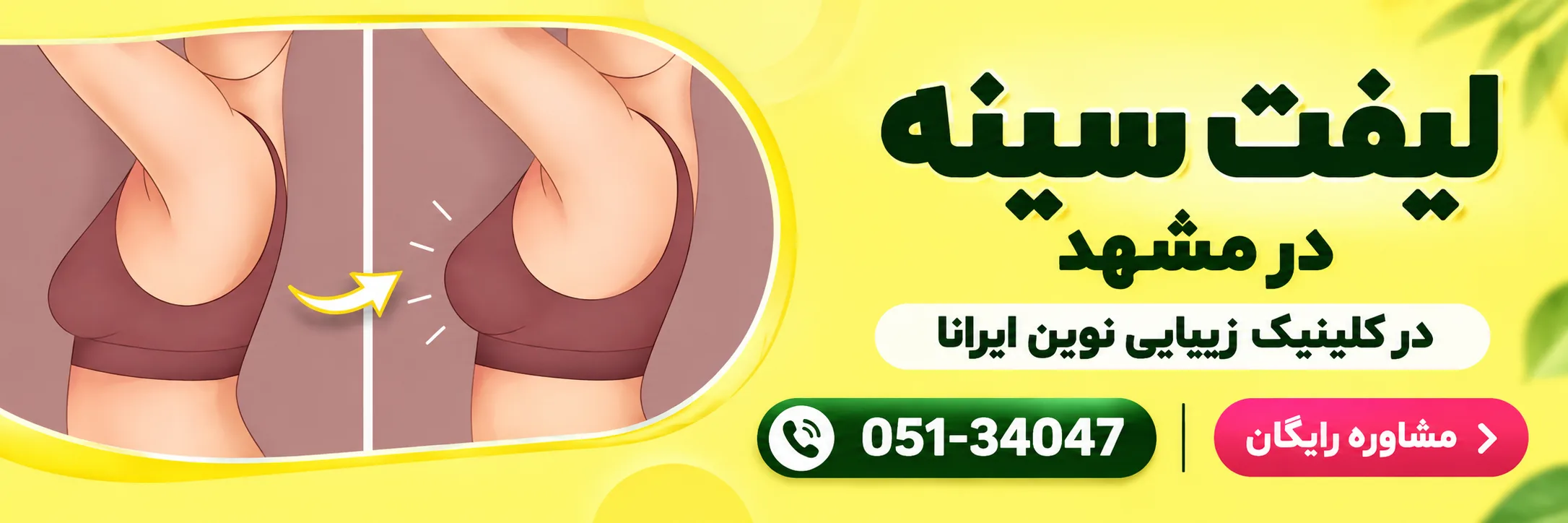 عمل لیفت سینه در کلینیک نوین ایرانا